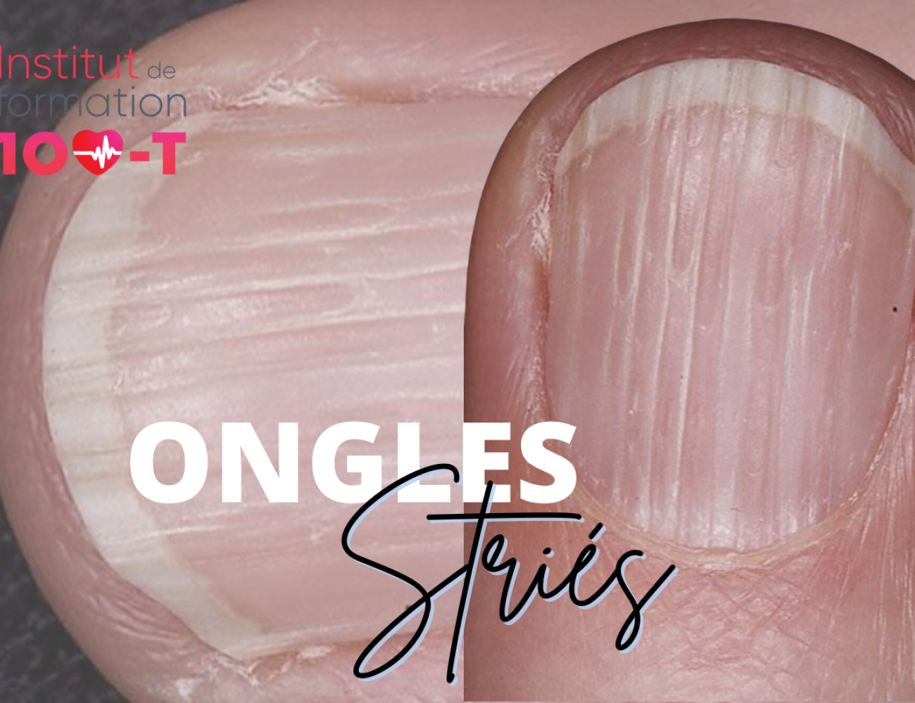 Ongles striés